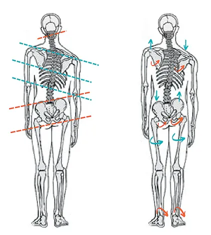 misaligned spine