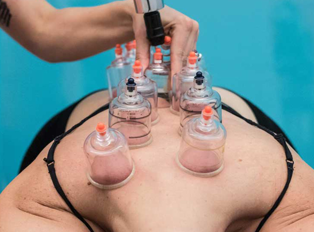 Vacuum Cupping Therapy at Thrive Proactive Health